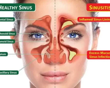 11 Homeopathic Home Remedies for Sinus Headaches