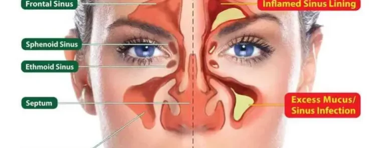 11 Homeopathic Home Remedies for Sinus Headaches