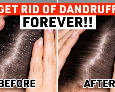 How to Get Rid of Dandruff: 7 Proven Natural Home Remedies