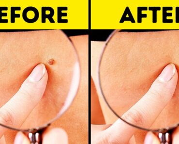 How to Remove Skin Tags: The Best Home Remedies!