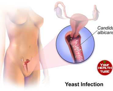 6 Effective Natural Home Remedies to Cure Yeast Infections Fast — No Prescription Needed!