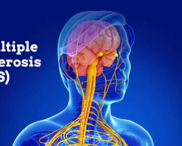 10 Powerful Herbs for Natural Multiple Sclerosis Treatment — Unlock the Healing Power of Nature!