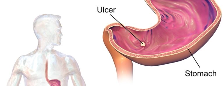 Stomach Ulcers: 4 Effective Natural Treatments