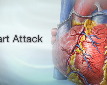 How to Stop a Heart Attack in 1 Minute (Recipe Included)