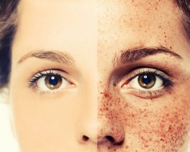 Apple Cider Vinegar helps in removing Freckles, Wrinkles and Acne