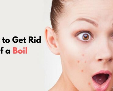 9 Amazing Home Remedies for Fast Relief of Boil