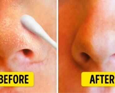 How to Get Rid And Prevent of Blackheads Naturally