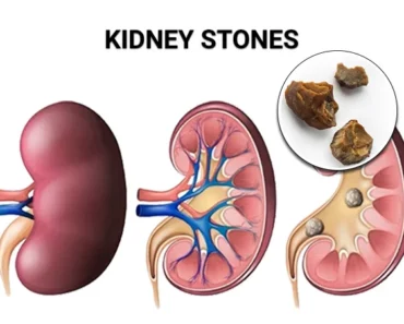 The Importance of a Kidney Cleansing Diet