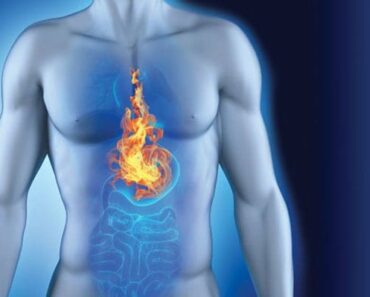 Surprising Causes of Acid Reflux