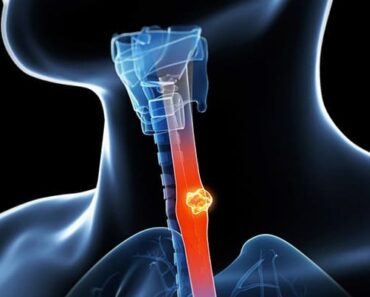 Esophageal Cancer: Causes, Symptoms, Treatment and Prevention