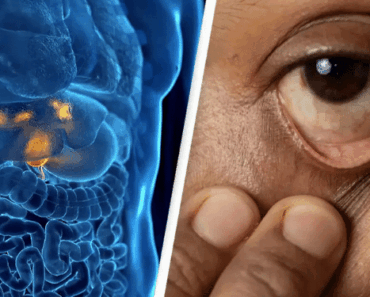 Little-Known Form of Cancer Is Spreading in Young People—and There’s Alarming Reason Why
