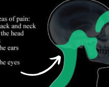 This Vitamin Deficiency Can Cause Headaches and Migraines: Here’s How to Fix It