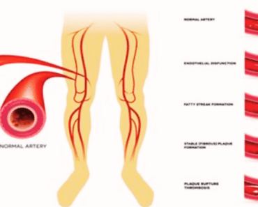 7 Natural Ways to Unclog Your Arteries—No Meds Required!