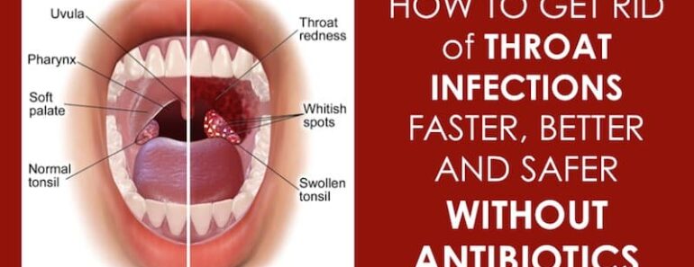 10 Effective Natural Home Remedies To Treat A Strep Throat Infection