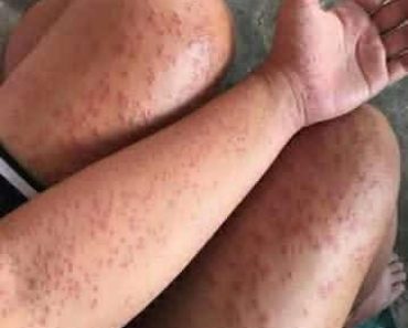 Woman Notices Strange Bumps After Staying in Old Apartment — Then She Realizes What Caused Them